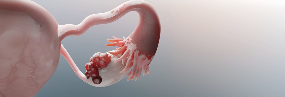 Especialista en diagnóstico y tratamiento de endometriosis en Puebla